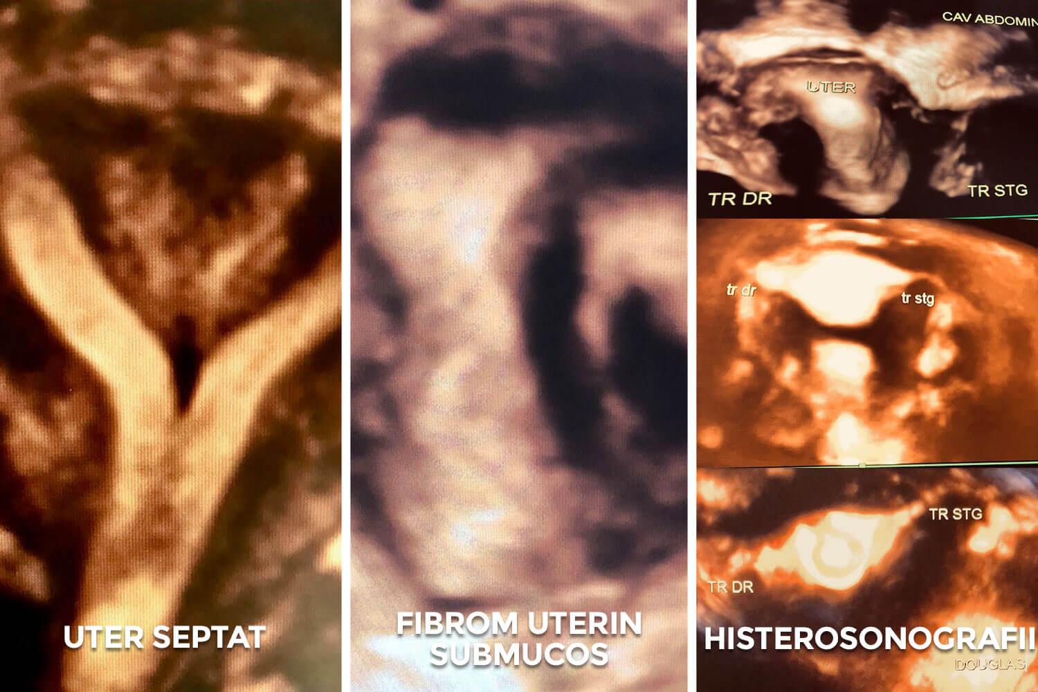 Ecografia de reconstrucție 3D a cavității uterine - Histerosonografia cu reconstrucția 3d a traiectului trompelor uterine - Dr. Valentina Vargolici I Femmeboutiquemedical.com