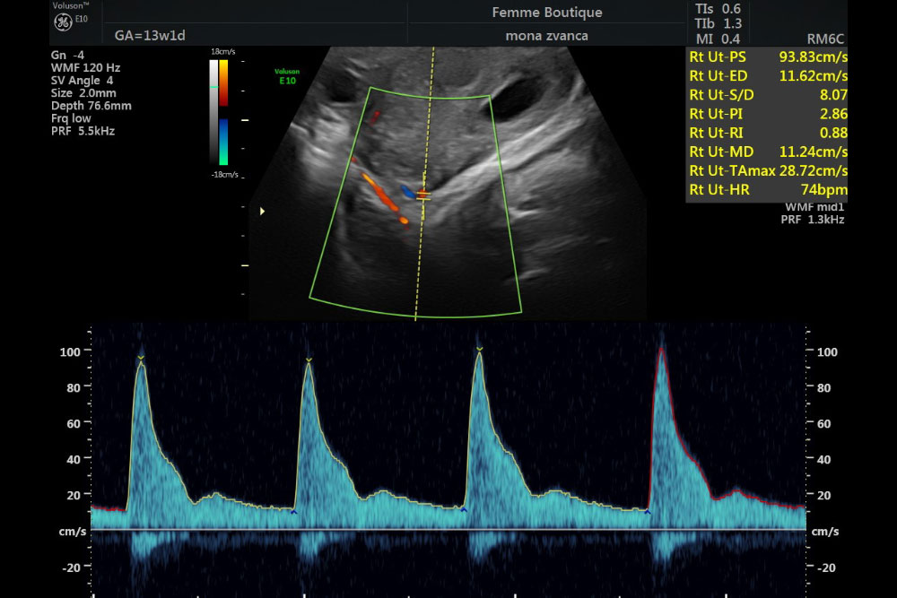 Ecografia Doppler in sarcina – care este rolul ei si cum te poate ajuta I Dr. Mona Zvanca, medic primar obstetrica - ginecologie, supraspecializare in medicina materno - fetala Femme Boutique Medical I Femmeboutiquemedical.com