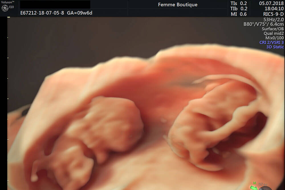 Sarcina gemelara si multipla si implicatii asupra fetilor si a mamemi - Dr. Ruxandra Albu - medic primar obstetrica - ginecologie si medicina materno - fetala. Doctor in stiinte medicale Femme Boutique Medical I Femmeboutiquemedical.com