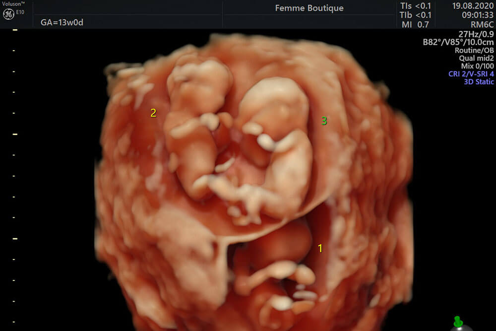 Sarcina gemelara si multipla si implicatii asupra fetilor si a mamemi - Dr. Ruxandra Albu - medic primar obstetrica - ginecologie si medicina materno - fetala. Doctor in stiinte medicale Femme Boutique Medical I Femmeboutiquemedical.com