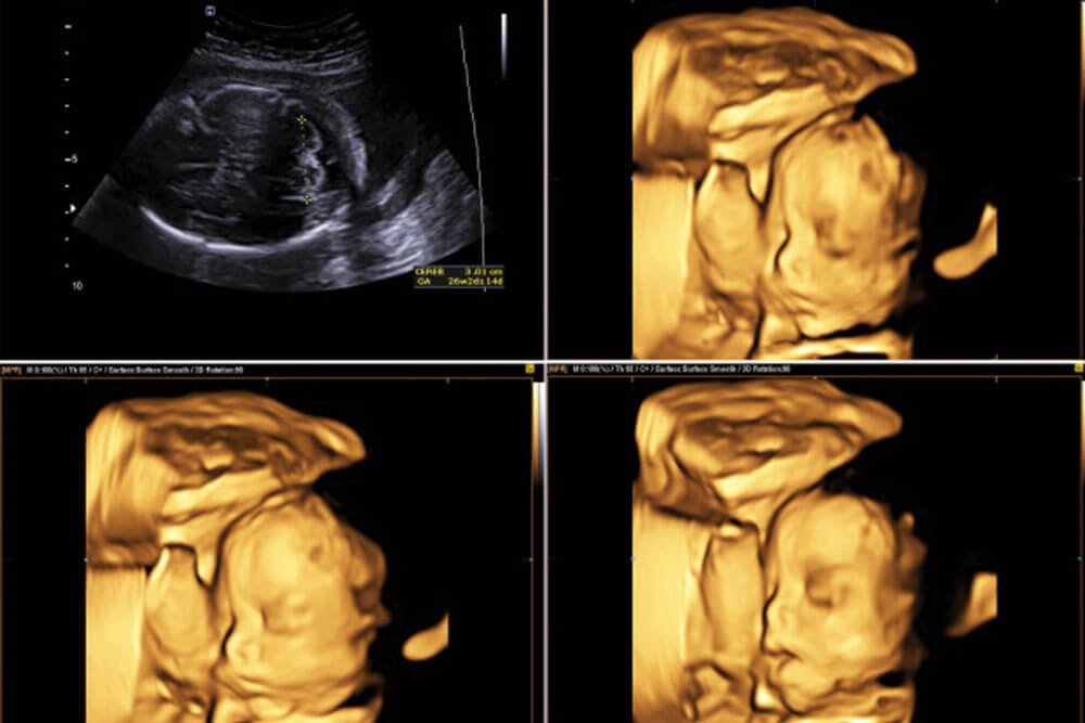 Malformatiile, anomaliile fetale - Dr. Mona Zvanca, medic primar obstetrica - ginecologie, supraspecializare in medicina materno - fetala Femme Boutique Medical I Femmeboutiquemedical.com
